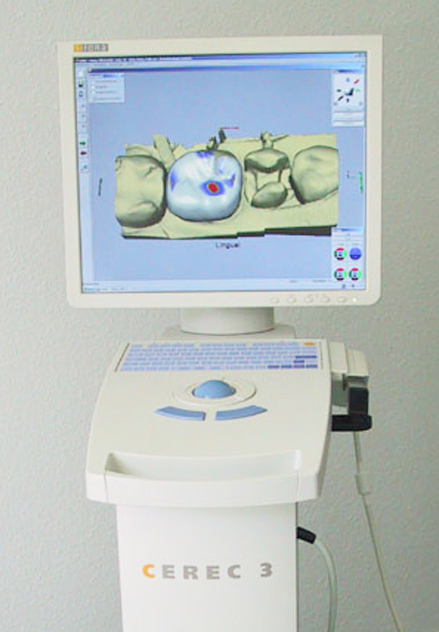 Cerec 3